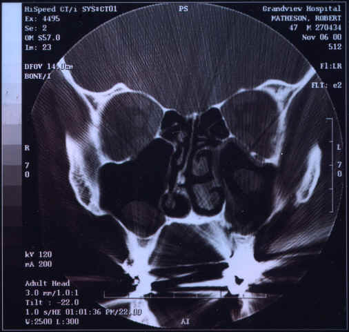 My deviated septum
